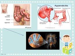 Penurunan asupan makanan dan peningkatan aktivitas tidur otomatis berdampak juga pada suhu tubuhnya. Preskas Peritonitis Ec Apendisitis Perforasi Pdf Txt