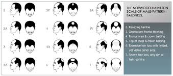 Alopecia In Men Dht Men Causes Of Hair Loss In Men