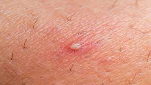 This should reduce itchiness and prevent infection. Ingrown Hair Cyst Causes Symptoms And Removal Treatment