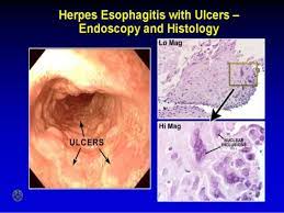 For the purpose of histological descriptions, the esophagus is subdivided into upper (entirely skeletal muscle in the muscularis externa),middle (mixed smooth and skeletal muscle) and lower (entirely. Herpetic Esophagitis