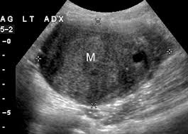Because pcos can cause irregular menstrual cycles, you may have trouble knowing when you're ovulating, which can make it harder for you to get pregnant. Adnexal Masses Us Characterization And Reporting Radiology