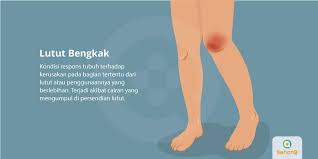 Lutut mengeluarkan suara gemeretak hingga terasa lemas dan sulit diluruskan. Lutut Bengkak Tanda Dan Gejala Penyebab Cara Mengobati Cara Mencegah