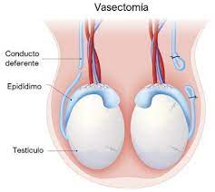 El tipo de vasectomía que te hiciste. Como Se Realiza La Vasectomia Tu Canal De Salud