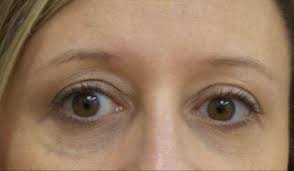 Our skin already thins as we age (due to a. Under Eye Blue Vein Treated With Laser Skincare Physicians