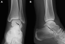 Image result for Ankle XRay