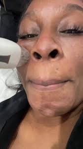 Rf microneedling before I hit these streets for #ciaa