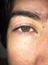 In an asian child or adult, possessing epicanthal folds is not associated with any type of health problems. I M Caucasian And I Have Noticeable Epicanthal Folds What Are My Options To Fix Them Photos