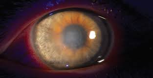 Recurrences are common and may lead to corneal hypoesthesia, ulceration, permanent scarring, and decreased vision. A Primer On Herpes Simplex Keratitis