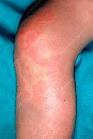 Image result for allergy rash on the legs