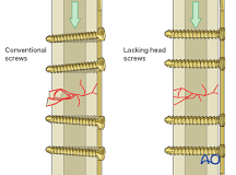 Locking plate principles