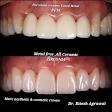 ZIRCONIA CROWN (Metal Free ,High strength,Natural looking) product image