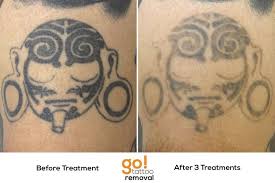 Making Steady Progress Fading This Thigh Piece So The Client Can Put Something New There After 3 Treatments Tattoo Removal Laser Tattoo Laser Tattoo Removal