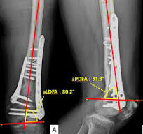 Fractures of the distal femur in elderly patients ...