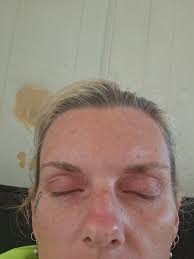 Most of the time when I put in durezol steroid eye drops it burns and  sometimes it doesn't. And this time it burns and will stay slightly burning  for awhile and causes