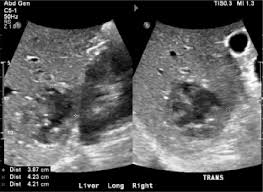 Look down at your tummy, and mentally divide the area from the bottom of your ribs down to your pubes into four quarters. Our Patient S Right Upper Quadrant Ruq Ultrasound Demonstrated A 3 9 Download Scientific Diagram