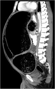 Hirschsprung S Disease In An Adult The American Journal Of Medicine