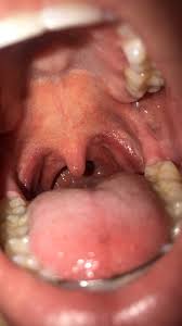 The infection is common among teenagers and young adults. Any Suggestions Infectious Mononucleosis Forums Patient