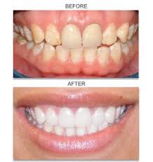 Pin On Snow Teeth Whitening Kit