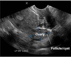 Maybe you would like to learn more about one of these? Gynecology Pelvic Ultrasound Made Easy Step By Step Guide Pocus 101