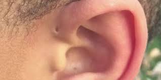 Seorang pria berusia 27 tahun bernama liam gomez mengeluhkan rasa sakit di telinganya dan juga mengalami vertigo yang rupanya merupakan tanda bahwa di dalam telinganya ada hewan yang tak ia sadari. Punya Lubang Kecil Di Atas Daun Telinga Simak Penjelasan Ini Halaman All Kompas Com