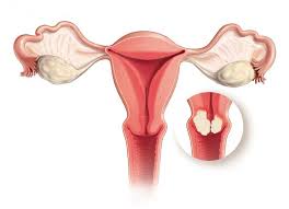 Marth c, landoni f, mahner s, et al; Cervical Cancer Causes Symptoms And Treatment Ns Medical Devices
