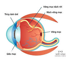 Thoái hóa võng mạc là gì? Có nguy hiểm không?