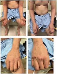 Image result for Atopic Patient
