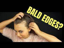 Pin By Jasmine Mahmood On Hair Styles Bald Spots Women Thinning Hairline Bald Spot