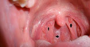 Mucus picks up dust particles, bacteria and other pollutants. Recognize Early Signs Of Throat Cancer For Prompt Treatment