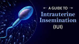 After iui, cm contained 1.0 x 10(6) to 57.0 x 10(6) sperm/ml; Intrauterine Insemination Iui Process For Infertility Treatment Youtube