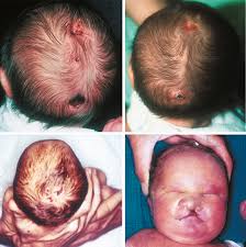 Image result for Craniotabes