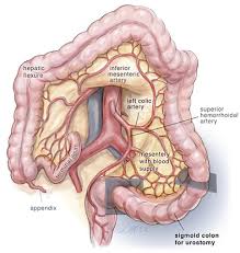 From wikipedia, the free encyclopedia. Concurrent Urinary And Bowel Diversion Surgical Modification With Sigmoid Colon That Avoids A Bowel Anastomosis