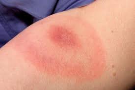 Chikungunya leptospirosis malaria dengue rashes differentiating diseases skin between hemorrhagic legs. Mvc February 2018 Department Of Public Health