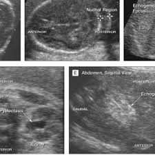 Pdf Second Trimester Ultrasound To Detect Fetuses With Down Syndrome