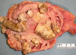 Qiao S Pathology Multiple Kidney Stones Herbs Image Kidney Stones Food