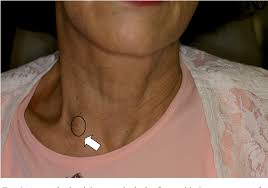 These structures can become inflamed and enlarged due to a the supraclavicular lymph nodes are located in the cavity over the clavicle, just on the side to where it merges with the sternum. Figure 1 From Tortuous Innominate Artery Simulating A Supraclavicular Subcutaneous Tumour Semantic Scholar