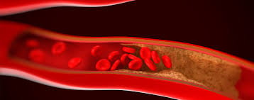 Erbrechen oder stuhl können auch schwarz oder sehr dunkelbraun sein. Arteriosklerose Symptome Erkennen Ursachen Verstehen Focus Arztsuche