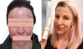 Shocking Image Reveals The Long Term Consequences Of Picking Your Skin Skin Picking Disorder Organic Skin Care Routine Organic Skin Care Regimen