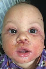 Image result for yellow scabs on the face in children