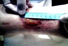 Check spelling or type a new query. Two Cases Of Hypertensive Martorell S Leg Ulcers Bmc Geriatrics Full Text