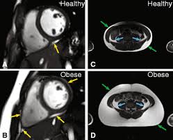 12 lead ecg & acs. Cardiac Remodeling And Dysfunction In Childhood Obesity A Cardiovascular Magnetic Resonance Study Journal Of Cardiovascular Magnetic Resonance Full Text