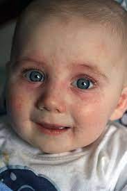 Pin On Food Allergies And Gluten