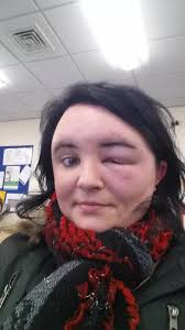 Allergic reaction to hair dye left me with eyes the size of golfballs,  claims mum