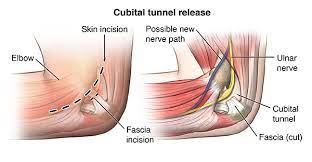 Recovery milestones for carpal tunnel release surgery. Cubital Tunnel Syndrome Treatment Manchester Hand Wrist Surgery