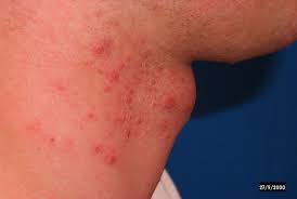 Image result for folliculitis symptoms