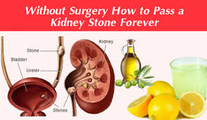 Without Surgery How To Pass A Kidney Stone Forever In 24 Hours 100 Working Right Home Remedies Kidney Stones Kidney Passing Kidney Stones