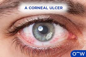 Image result for Cornea