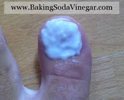 toenail fungus treatment baking soda