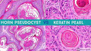 Squamous cell carcinoma in a camelus dromedarius a case report there were many small nests with occasional keratin pearls and growth of single cells in the shallow lamina propria figure 2d and figure 2e. Keratin Pearl Scc Vs Horn Pseudocyst Sk Aka Pseudohorn Cyst Youtube