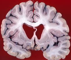 Huntington S Disease